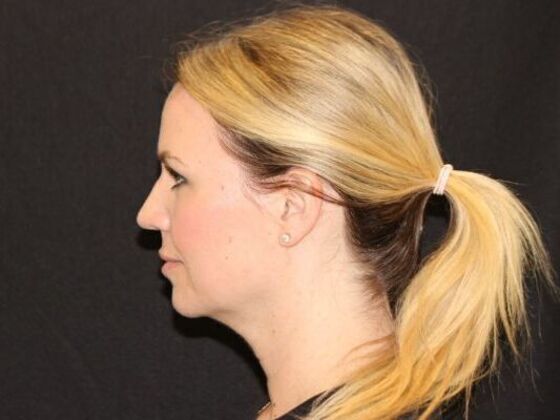 Injectables: Case 94 - After