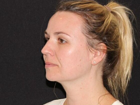 Injectables: Case 94 - Before