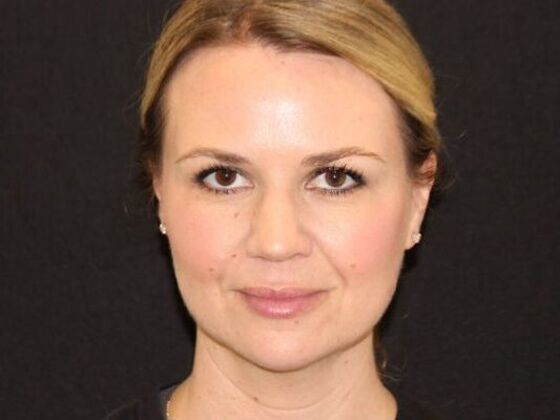 Injectables Case 94 - After