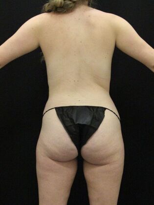 Liposuction Case 58 - Before