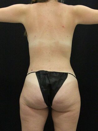 Liposuction Case 58 - After