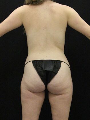 Tummy Tuck: Case 71 - Before