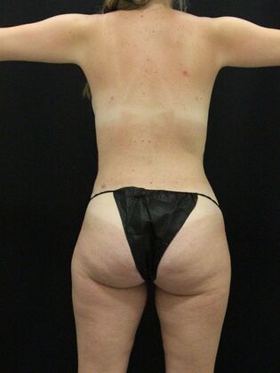 Tummy Tuck: Case 71 - After