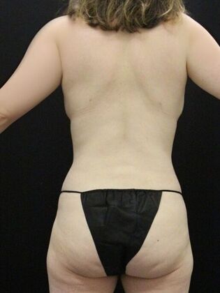 Liposuction Case 51 - After