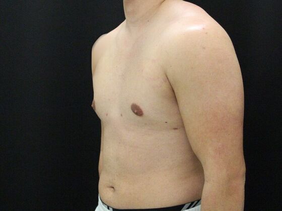 Gynecomastia & Male Breast Reduction Case 4 - After