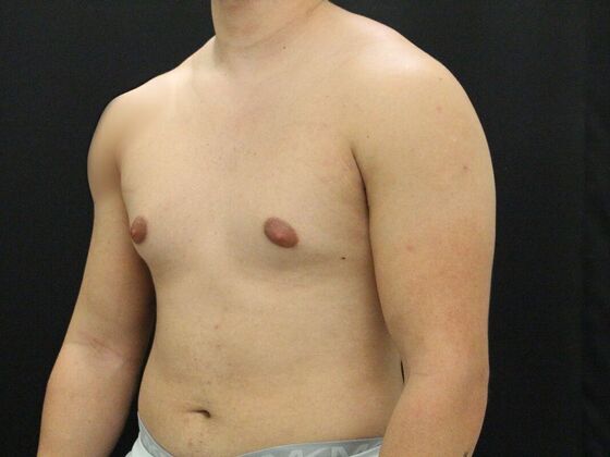 Gynecomastia & Male Breast Reduction Case 4 - Before