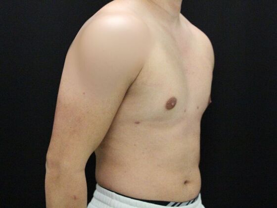 Gynecomastia & Male Breast Reduction: Case 4 - After