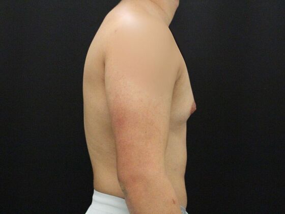 Gynecomastia & Male Breast Reduction: Case 4 - Before