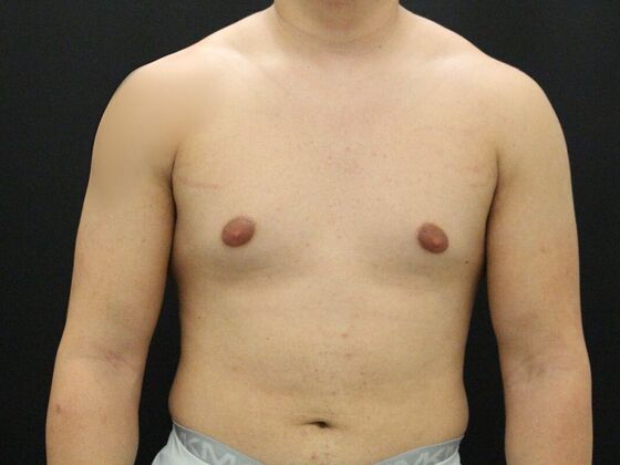 Gynecomastia & Male Breast Reduction: Case 4 - Before