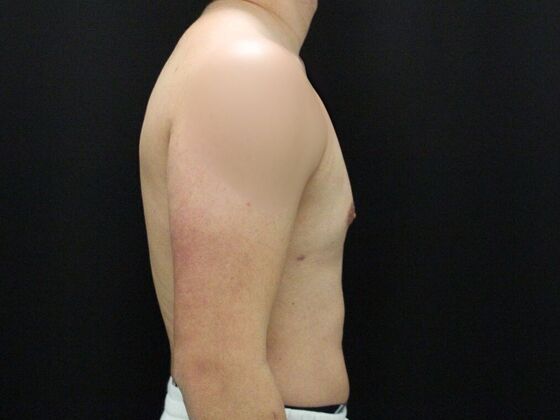 Gynecomastia & Male Breast Reduction: Case 4 - After
