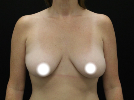 Breast Lift/Breast Lift Augmentation Case 66 - Before