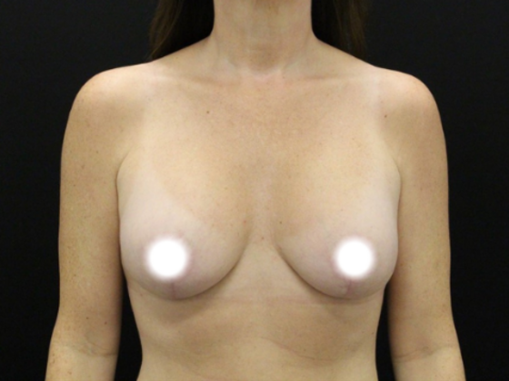 Breast Lift/Breast Lift Augmentation Case 66 - After