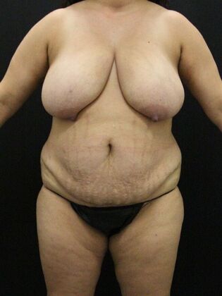 Tummy Tuck Case 82 - Before