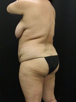 Tummy Tuck: Case 82 - Before