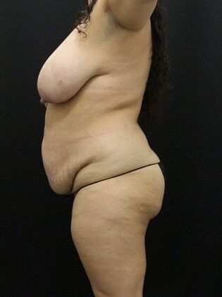 Tummy Tuck: Case 82 - Before