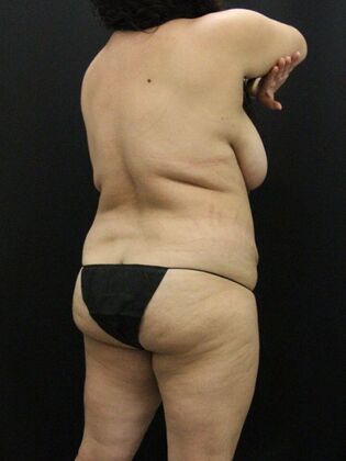 Tummy Tuck: Case 82 - Before