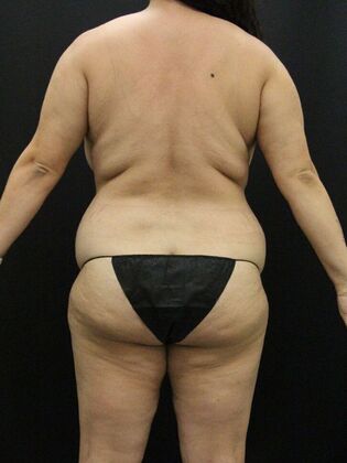 Tummy Tuck: Case 82 - Before