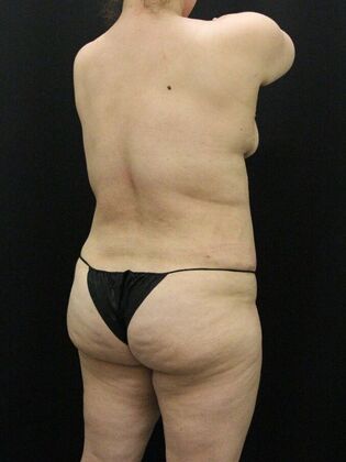 Tummy Tuck: Case 82 - After