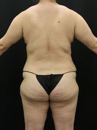 Tummy Tuck: Case 82 - After