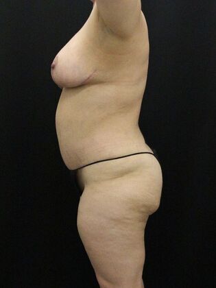 Tummy Tuck: Case 82 - After