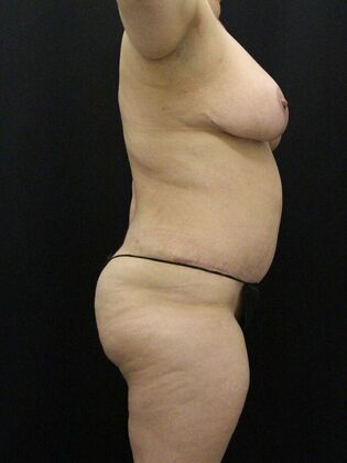 Tummy Tuck: Case 82 - After