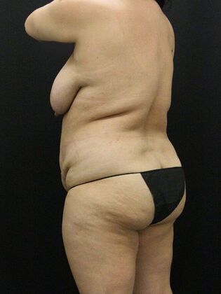 Liposuction: Case 41 - Before