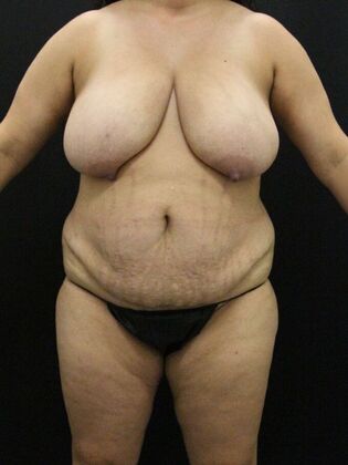 Liposuction Case 41 - Before