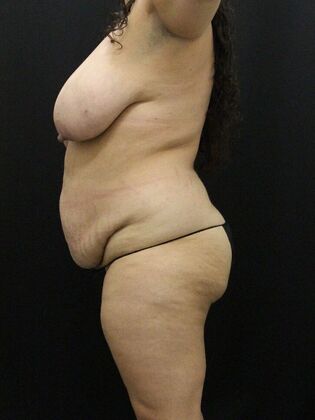 Liposuction: Case 41 - Before