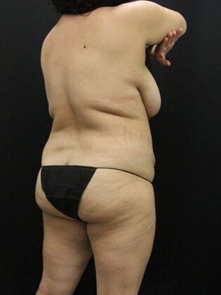 Liposuction: Case 41 - Before