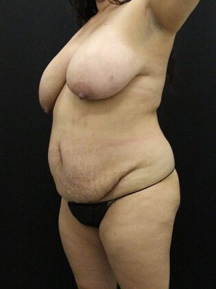 Liposuction: Case 41 - Before