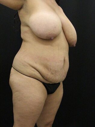 Liposuction: Case 41 - Before