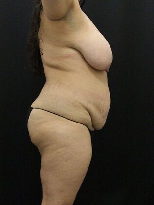 Liposuction: Case 41 - Before