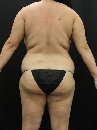 Liposuction: Case 41 - Before