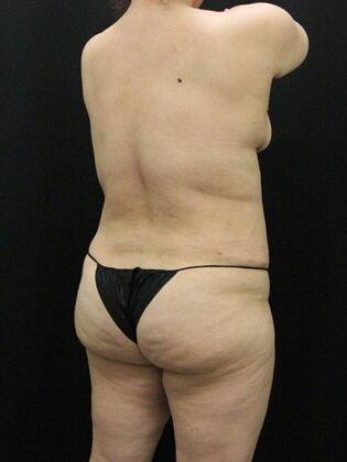 Liposuction: Case 41 - After