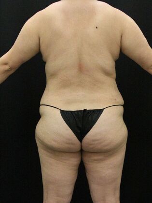 Liposuction: Case 41 - After
