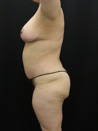 Liposuction: Case 41 - After