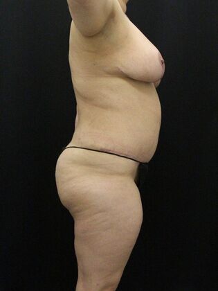 Liposuction: Case 41 - After