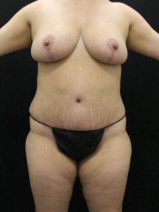 Liposuction Case 41 - After