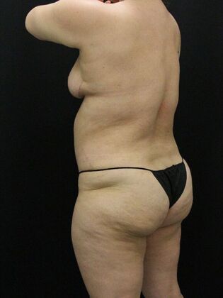 Liposuction: Case 41 - After
