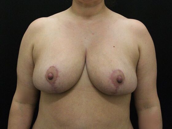 Breast Reduction Case 31 - After