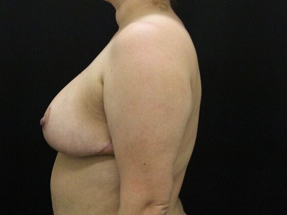 Breast Reduction: Case 31 - After