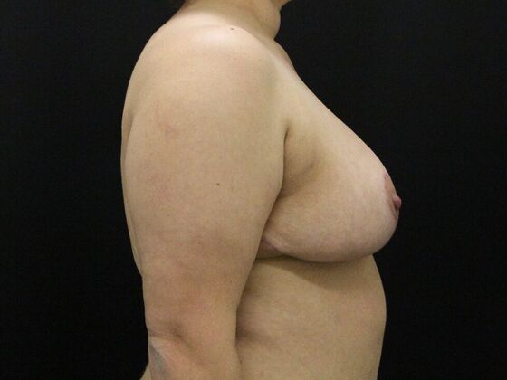 Breast Reduction: Case 31 - After