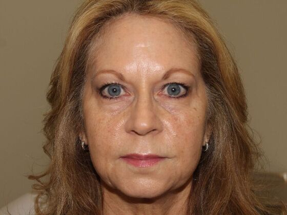 Injectables Case 95 - After