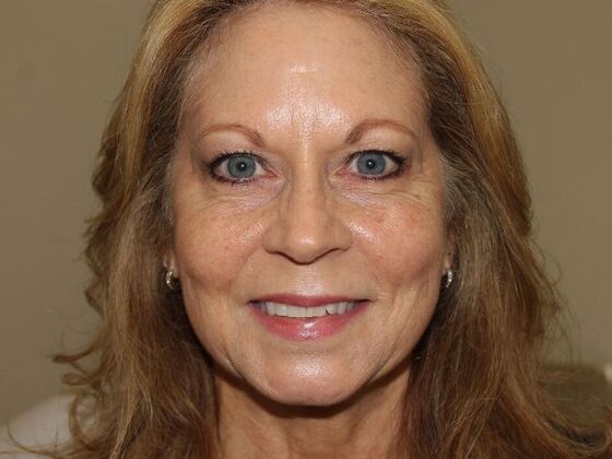 Injectables: Case 95 - After