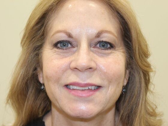 Injectables: Case 95 - Before