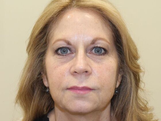 Injectables Case 95 - Before