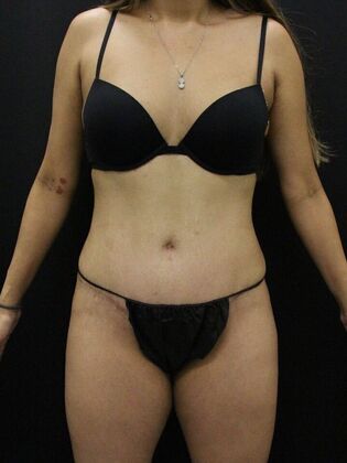 Tummy Tuck Case 83 - After