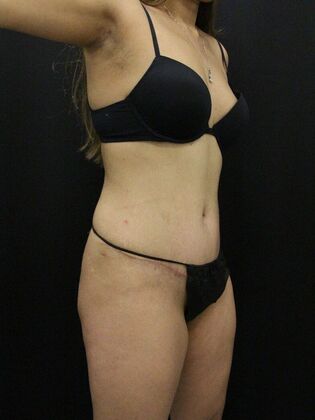 Tummy Tuck: Case 83 - After