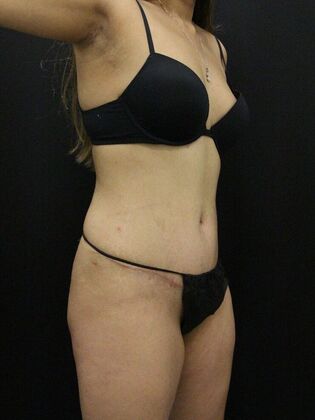 Liposuction: Case 42 - After
