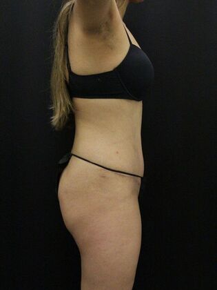 Liposuction: Case 42 - After